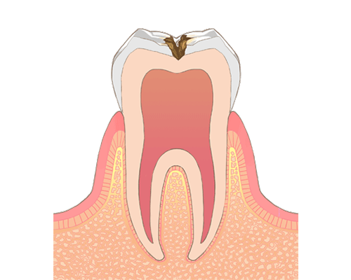 虫歯治療 矢部駅近くの歯医者さんなら宗正歯科医院 相模原市中央区淵野辺 虫歯治療 矢部駅近くの歯医者さんなら宗正歯科医院 相模原市中央区淵野辺